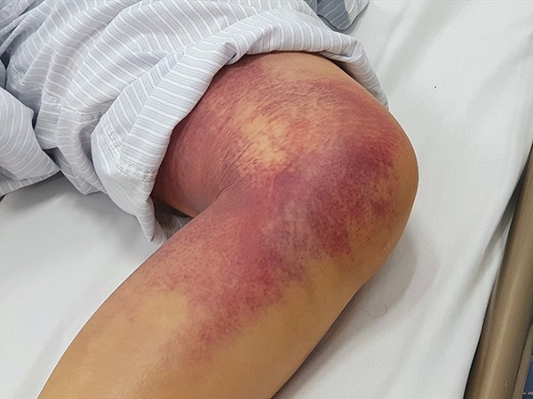 Nằm mơ thấy bị rắn cắn là điềm gì, hên hay xui?