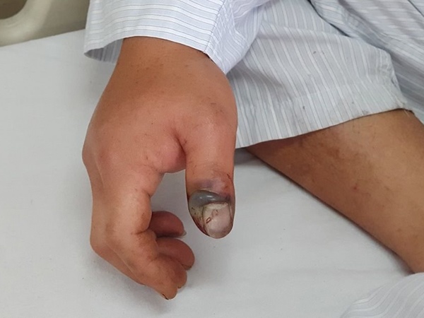 Nằm mơ thấy bị rắn cắn vào tay có phải điềm nguy hiểm?