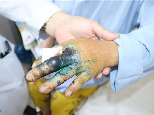 Mơ thấy bị rắn độc cắn là điềm gì, hung hay lành?